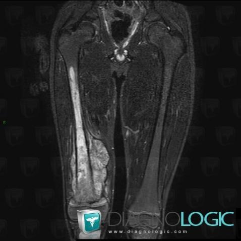 Osteosarcoma, Other soft tissues/nerves - Thigh, Femur - Mid part, MRI