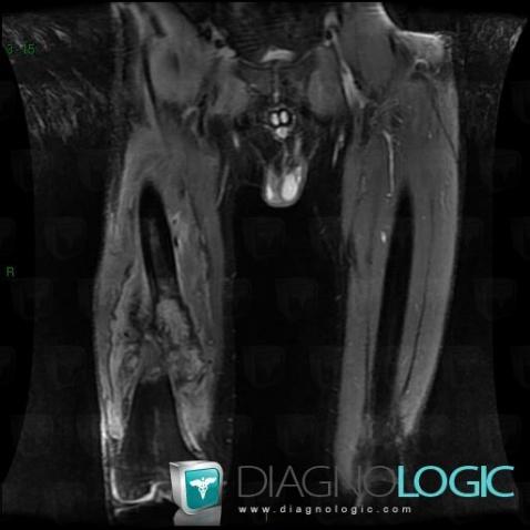 Osteosarcoma, Other soft tissues/nerves - Thigh, Femur - Mid part, MRI