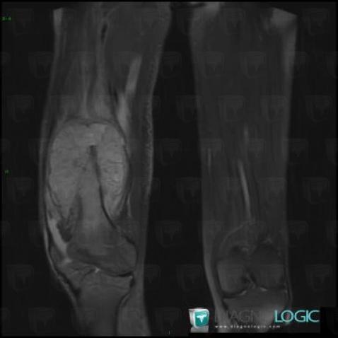 Osteosarcoma, Other soft tissues/nerves - Thigh, MRI