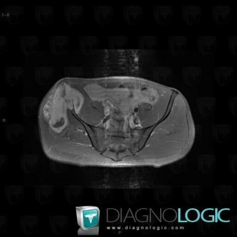 Osteosarcoma, Pelvic Muscles, MRI