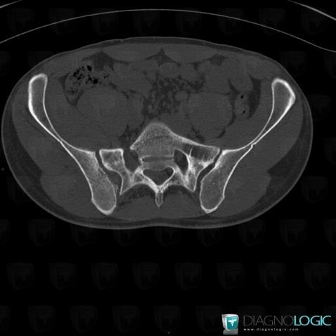 Osteosarcoma, Sacrum / Coccyx, CT