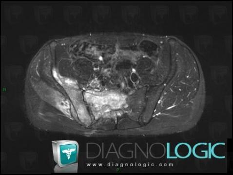 Osteosarcoma, Sacrum / Coccyx, MRI