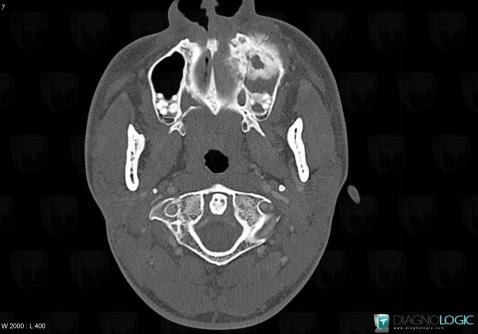 Osteosarcoma, Sinus, CT