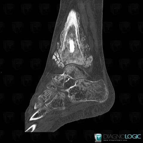 Osteosarcoma, Tibia - Distal part, CT