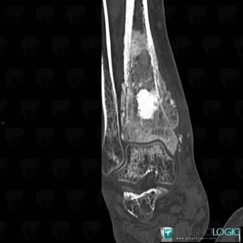 Osteosarcoma, Tibia - Distal part, CT