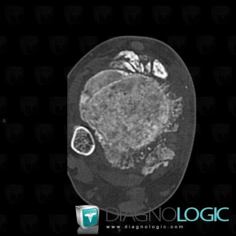 Osteosarcoma, Tibia - Distal part, CT