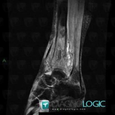 Osteosarcoma, Tibia - Distal part, MRI