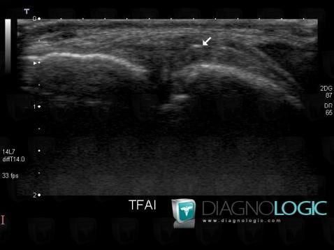 Other ligament injury / Ankle, Other ligaments - Ankle, US