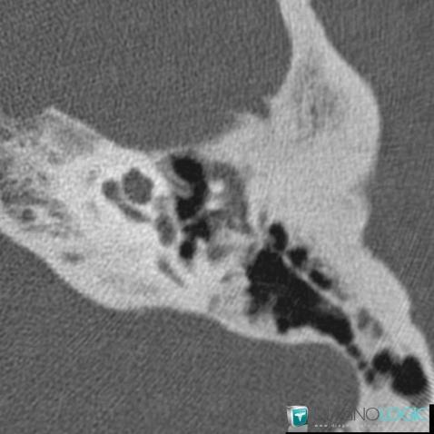 Otosclerosis, Temporal bone, CT