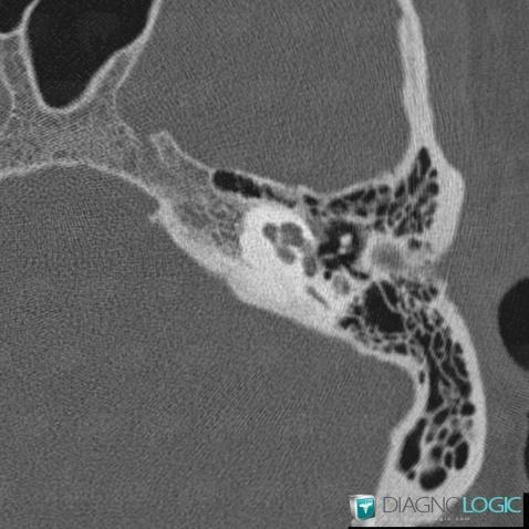 Otosclerosis, Temporal bone, CT