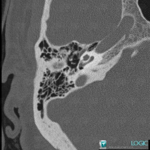 Otosclerosis, Temporal bone, CT