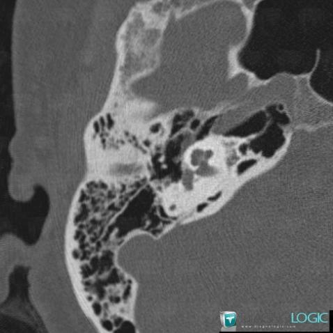 Otosclerosis, Temporal bone, CT