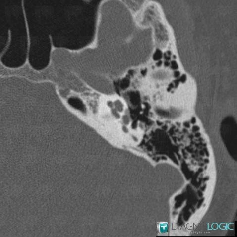 Otosclerosis, Temporal bone, CT