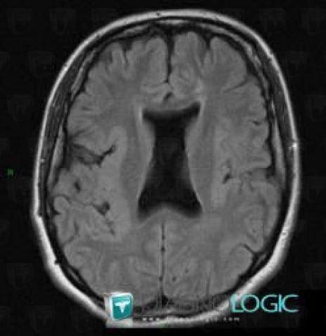 Radiology case : Pachygyria (MRI) - Diagnologic