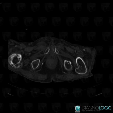 Paget disease, Femur - Mid part, CT