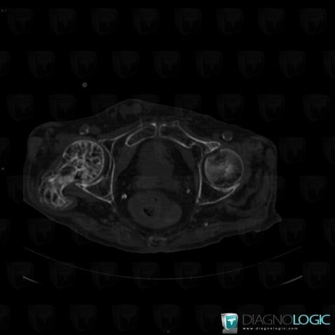 Paget disease, Femur - Proximal part, CT