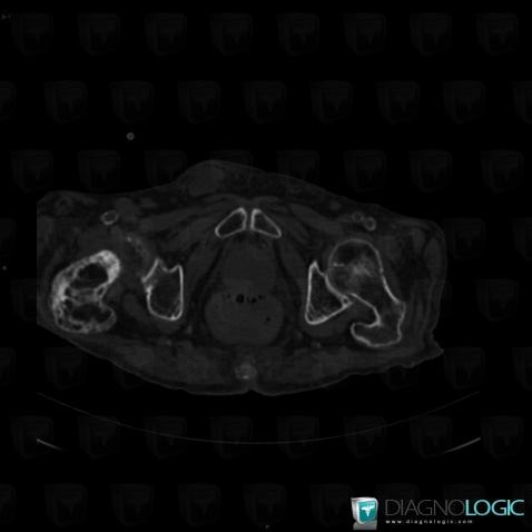 Paget disease, Femur - Proximal part, CT