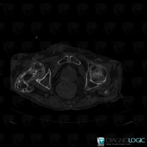 Paget disease, Femur - Proximal part, CT