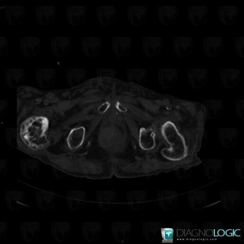 Paget disease, Femur - Proximal part, CT