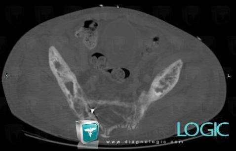 Paget disease, Ilium, CT