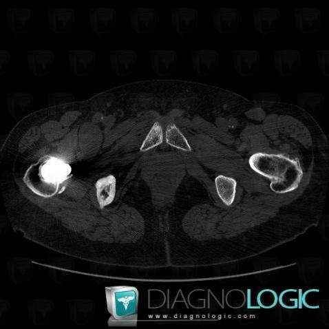 Paget disease, Ilium, CT