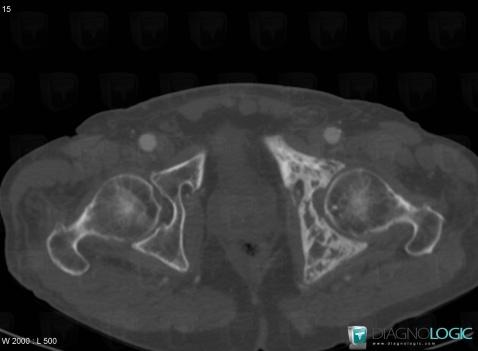 Paget disease, Ilium, CT