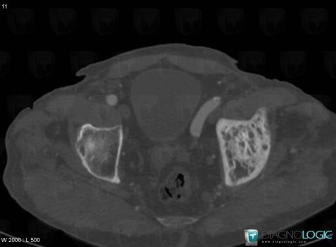 Paget disease, Ilium, CT