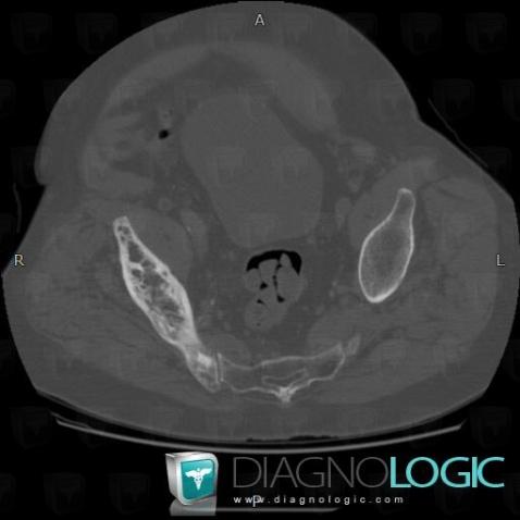 Paget disease, Ilium, CT