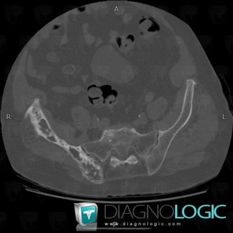 Paget disease, Ilium, CT