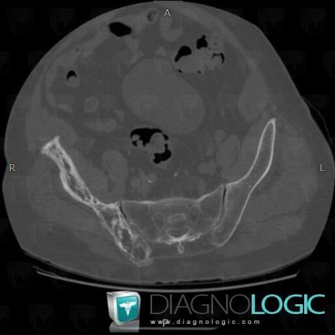 Paget disease, Ilium, CT