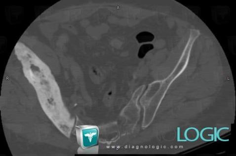 Paget disease, Ilium, CT