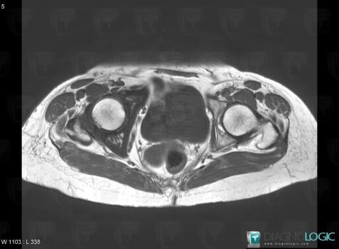 Paget disease, Ilium, MRI