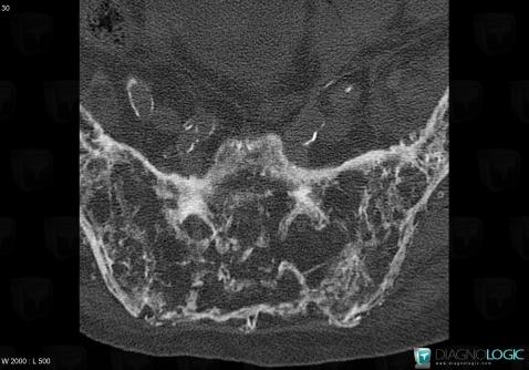 Paget disease, Ilium, Sacrum / Coccyx, CT