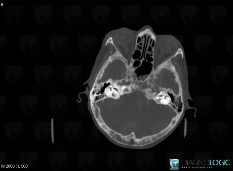 Paget disease, Orbital bones, CT