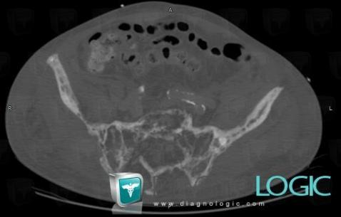 Paget disease, Sacrum / Coccyx, CT