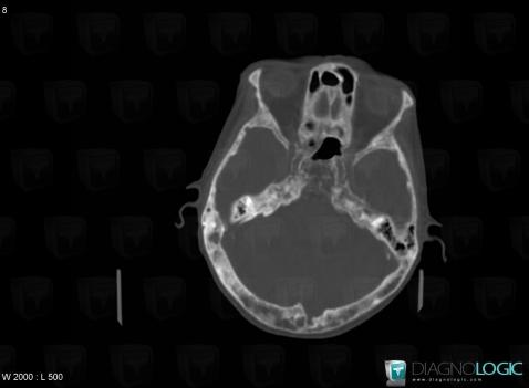 Paget disease, Skull vault, CT