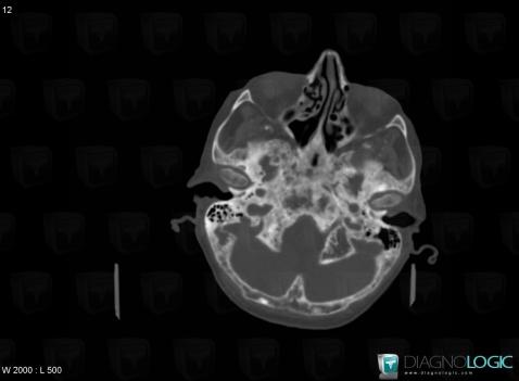 Paget disease, Sphenoid bone, CT