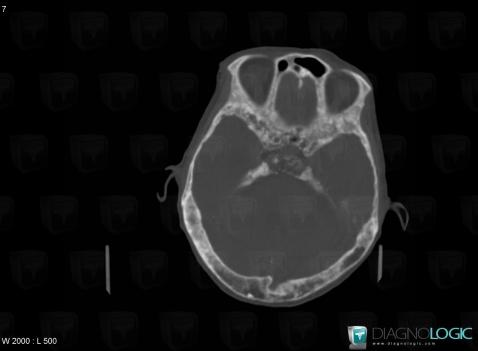 Paget disease, Temporal bone, CT