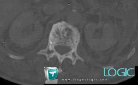 Paget disease, Vertebral body / Disk, CT