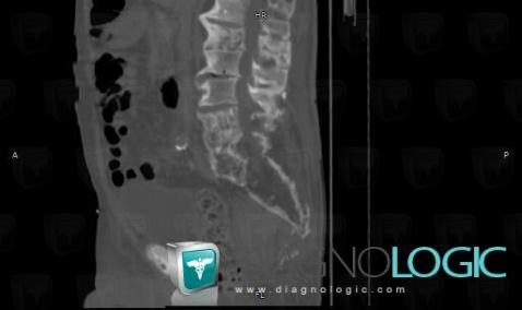 Paget disease, Vertebral body / Disk, CT