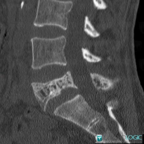 Paget disease, Vertebral body / Disk, CT