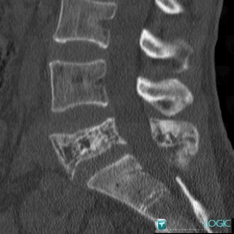 Paget disease, Vertebral body / Disk, CT