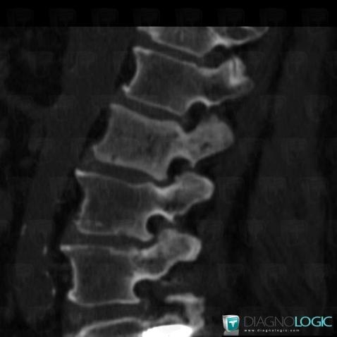 Radiology Case Paget Disease Ct Diagnologic