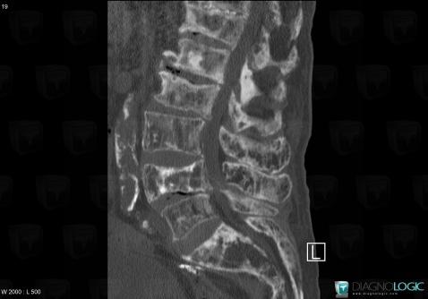 Paget disease, Vertebral body / Disk, CT