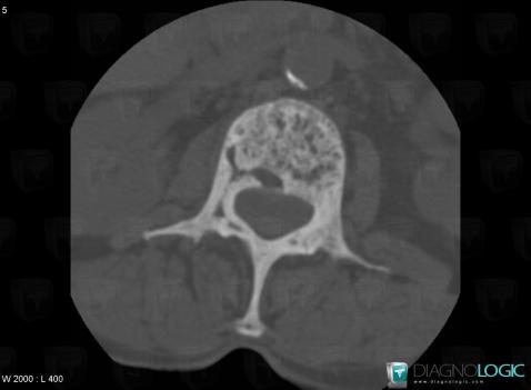 Paget disease, Vertebral body / Disk, CT