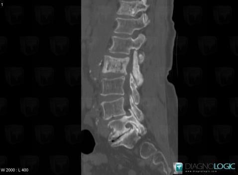 Paget disease, Vertebral body / Disk, CT