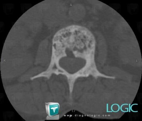 Paget disease, Vertebral body / Disk, CT