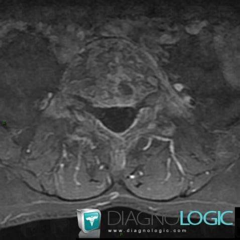 Paget disease, Vertebral body / Disk, MRI