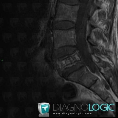 Paget disease, Vertebral body / Disk, MRI