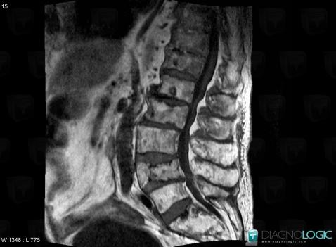 Paget disease, Vertebral body / Disk, MRI